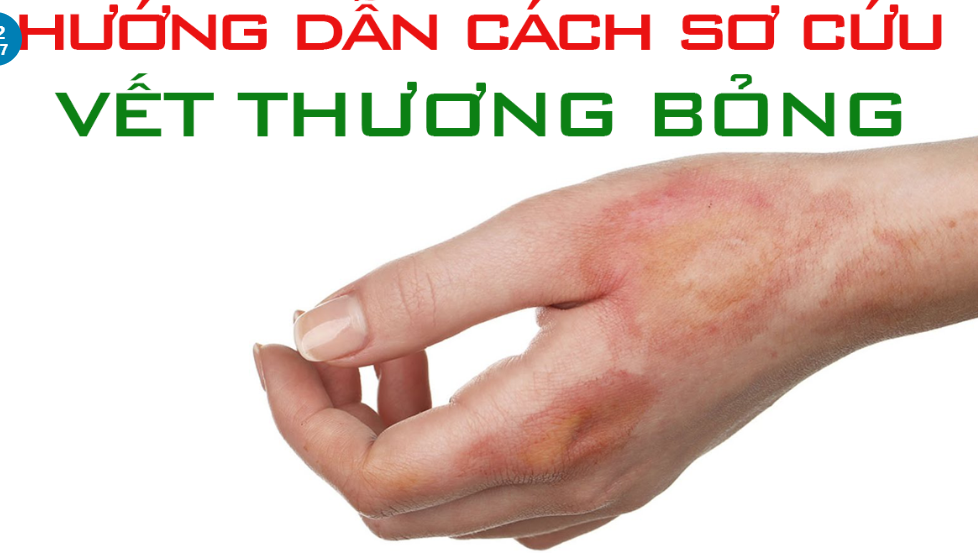 HƯỚNG DẪN SƠ CỨU NGƯỜI BỊ BỎNG DO CHÁY
